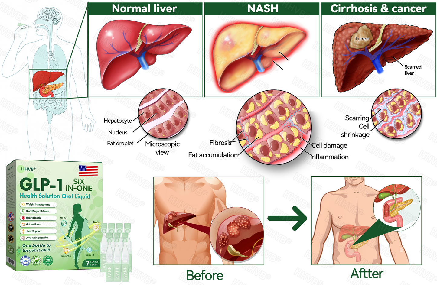 🇺🇸𝑶𝒇𝒇𝒊𝒄𝒊𝒂𝒍 𝑺𝒕𝒐𝒓𝒆  | 𝑯𝑯𝑽𝑩®🎁🎁𝐺𝐿𝑃-𝟏  𝑺𝑰𝑿 𝑰𝑵-𝑶𝑵𝑬 𝑯𝒆𝒂𝒍𝒕𝒉 𝑺𝒐𝒍𝒖𝒕𝒊𝒐𝒏 𝑶𝒓𝒂𝒍 𝑳𝒊𝒒𝒖𝒊𝒅  (𝐉𝐮𝐬𝐭 𝐨𝐧𝐜𝐞 𝐚 𝐝𝐚𝐲, 𝐯𝐢𝐬𝐢𝐛𝐥𝐞 𝐜𝐡𝐚𝐧𝐠𝐞𝐬 𝐢𝐧 𝟕 𝐝𝐚𝐲𝐬） ✅ 𝐅𝐨𝐫 𝐨𝐛𝐞𝐬𝐢𝐭𝐲, 𝐜𝐚𝐫𝐝𝐢𝐨𝐯𝐚𝐬𝐜𝐮𝐥𝐚𝐫 𝐡𝐞𝐚𝐥𝐭𝐡, 𝐝𝐢𝐚𝐛𝐞𝐭𝐞𝐬, 𝐬𝐥𝐞𝐞𝐩 𝐚𝐩𝐧𝐞𝐚, 𝐣𝐨𝐢𝐧𝐭 𝐢𝐬𝐬𝐮𝐞𝐬, 𝐚𝐧𝐝 𝐦𝐨𝐫𝐞