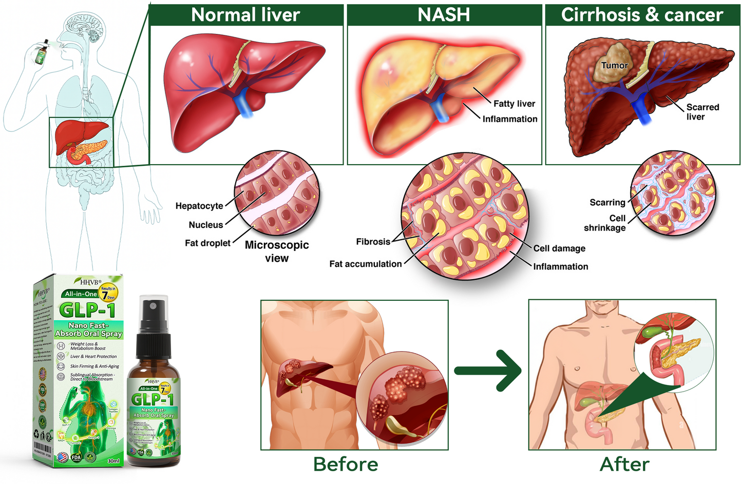 𝑶𝒇𝒇𝒊𝒄𝒊𝒂𝒍 𝑺𝒕𝒐𝒓𝒆 | 𝐇𝐇𝖵𝘽® 🏅✨𝐺𝐿𝑃-𝟏  All-𝒊𝒏-𝑶𝒏𝒆 Nano Fast-Absorb Oral Spray  (𝐉𝐮𝐬𝐭 2 -3 𝒕𝒊𝒎𝒆𝒔 𝐚 𝐝𝐚𝐲, 𝐯𝐢𝐬𝐢𝐛𝐥𝐞 𝐜𝐡𝐚𝐧𝐠𝐞𝐬 𝐢𝐧 𝟕 𝐝𝐚𝐲𝐬） ✅ 𝐅𝐨𝐫 𝐨𝐛𝐞𝐬𝐢𝐭𝐲, 𝐜𝐚𝐫𝐝𝐢𝐨𝐯𝐚𝐬𝐜𝐮𝐥𝐚𝐫 𝐡𝐞𝐚𝐥𝐭𝐡, 𝐝𝐢𝐚𝐛𝐞𝐭𝐞𝐬, 𝐬𝐥𝐞𝐞𝐩 𝐚𝐩𝐧𝐞𝐚, 𝐆𝐮𝐭 𝐇𝐞𝐚𝐥𝐭𝐡, 𝐣𝐨𝐢𝐧𝐭 𝐢𝐬𝐬𝐮𝐞𝐬, 𝐚𝐧𝐝 𝐦𝐨𝐫𝐞